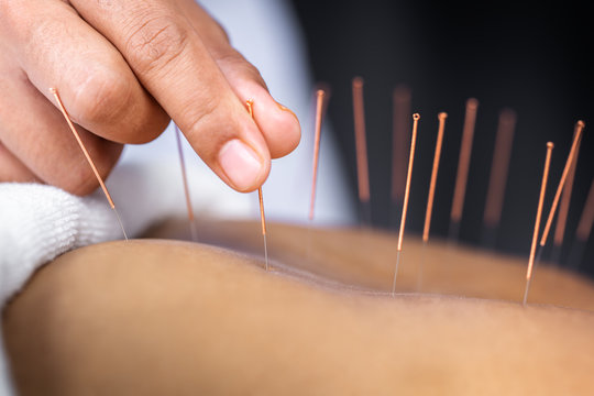 Acupuncture: close-up of acupuncture needles during treatment on patient